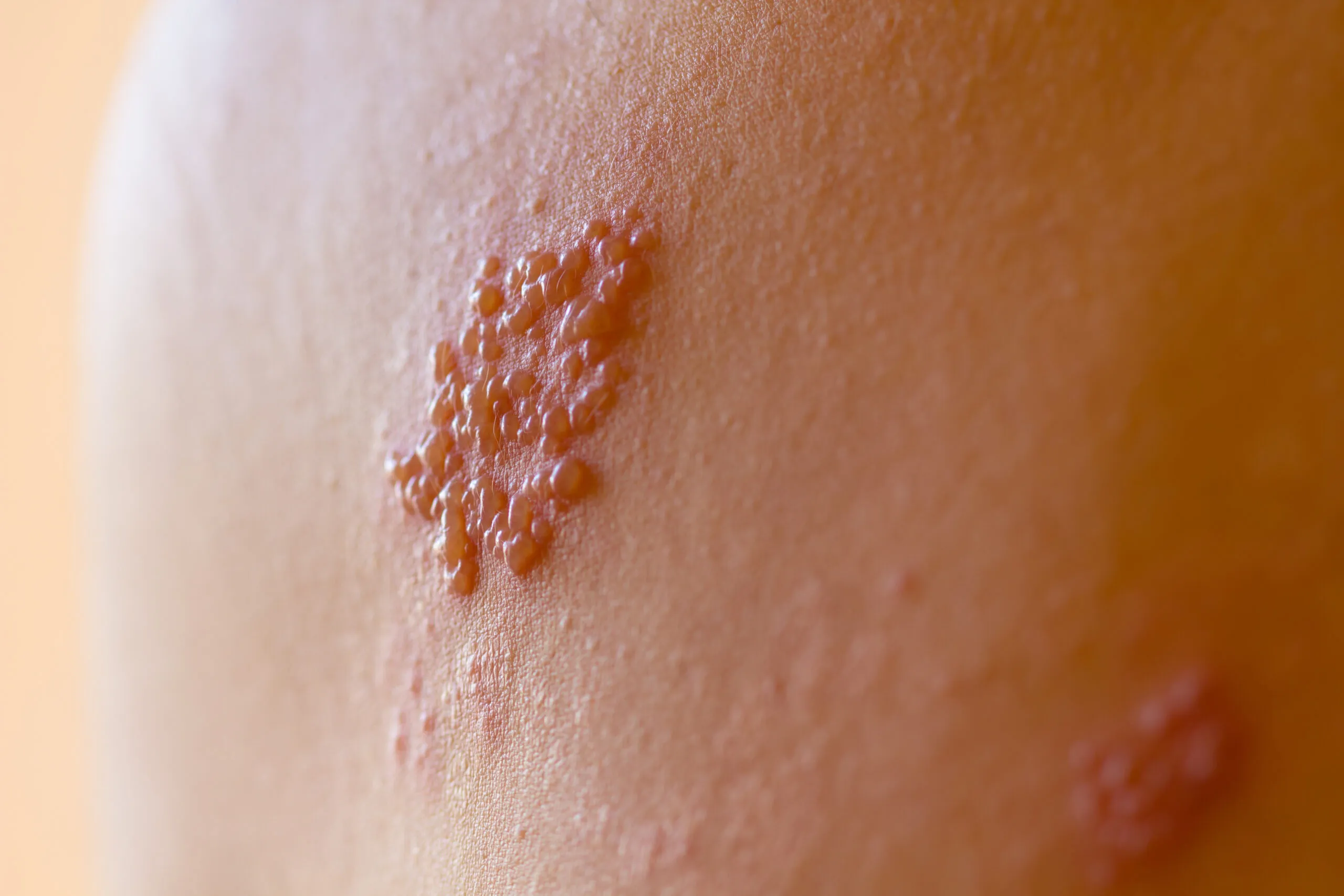 How Shingles Develops: From Chickenpox Virus to Painful Rash | Derm Collective North Shore in Northbrook, IL
